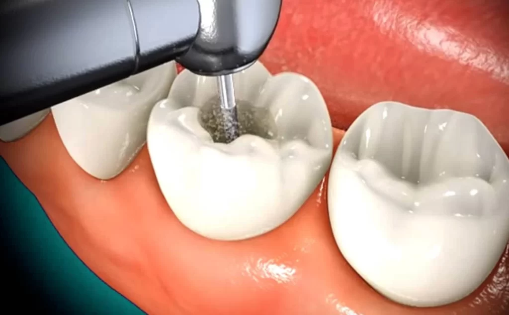 Do You Need a Dental Filling a Root Canal Treatment in Grand Valley?